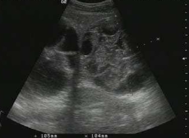 liver ultrasonography